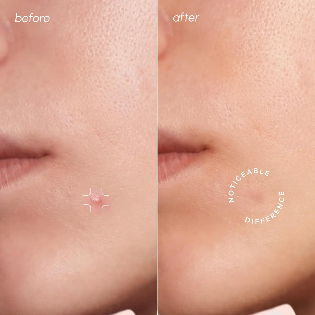 Maree - Invisible Pimple & Acne Patches