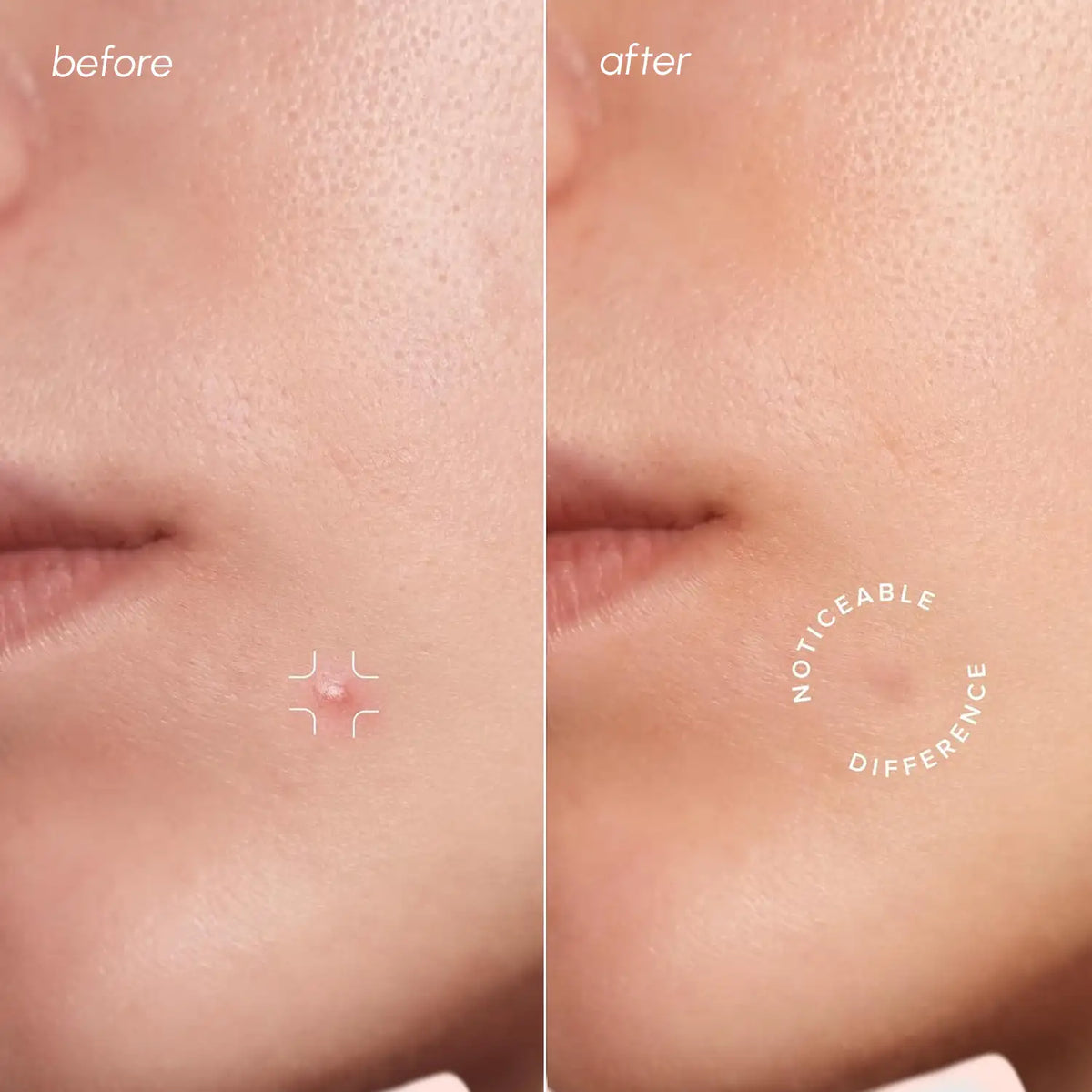Maree - Invisible Pimple & Acne Patches