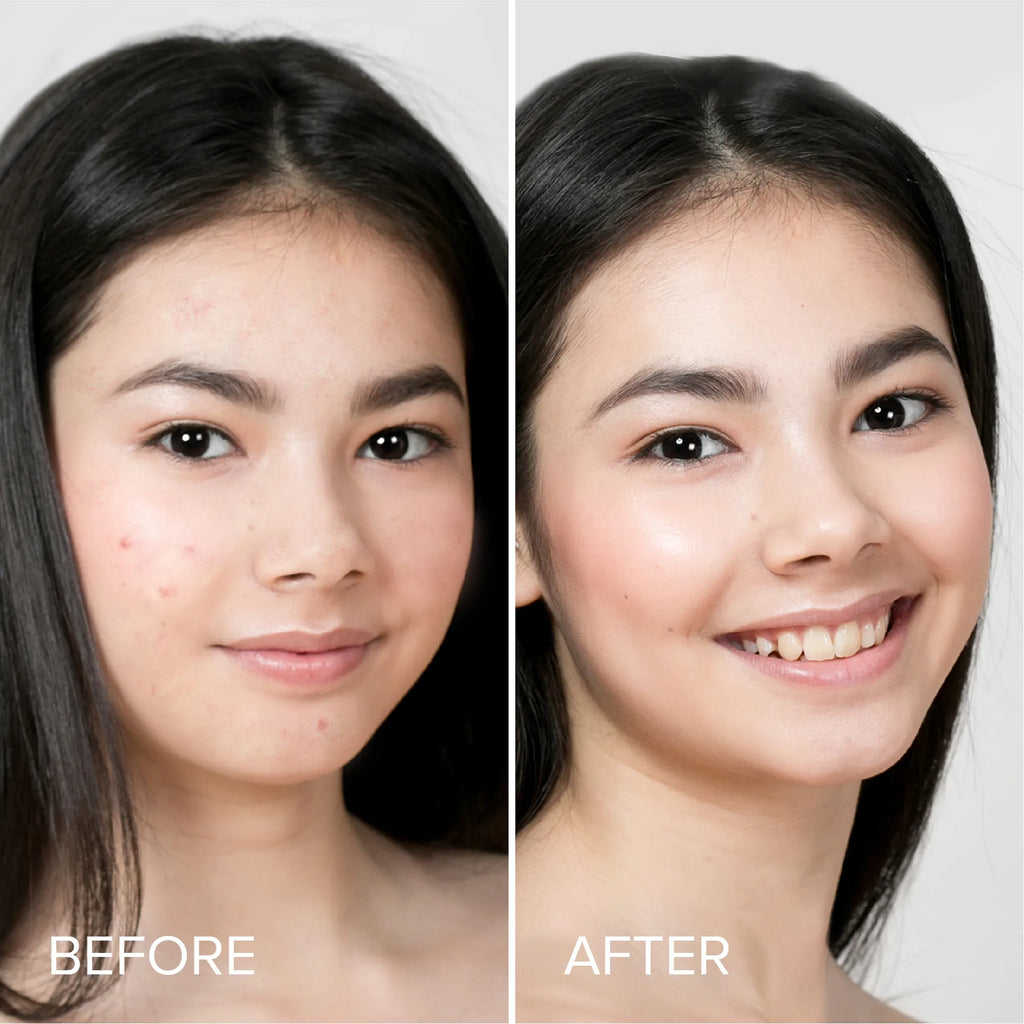 Maree - Pimple & Acne Patches