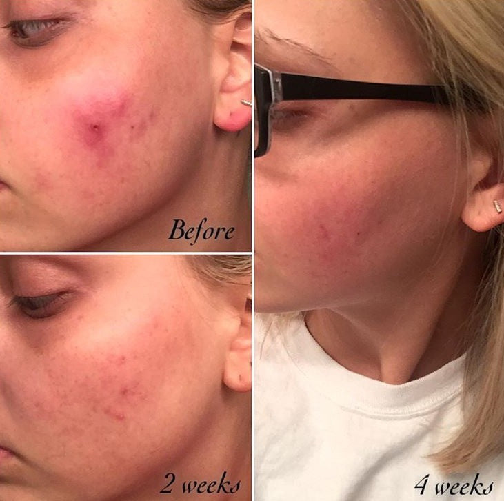 Timeless Organics - 3-Step Acne System