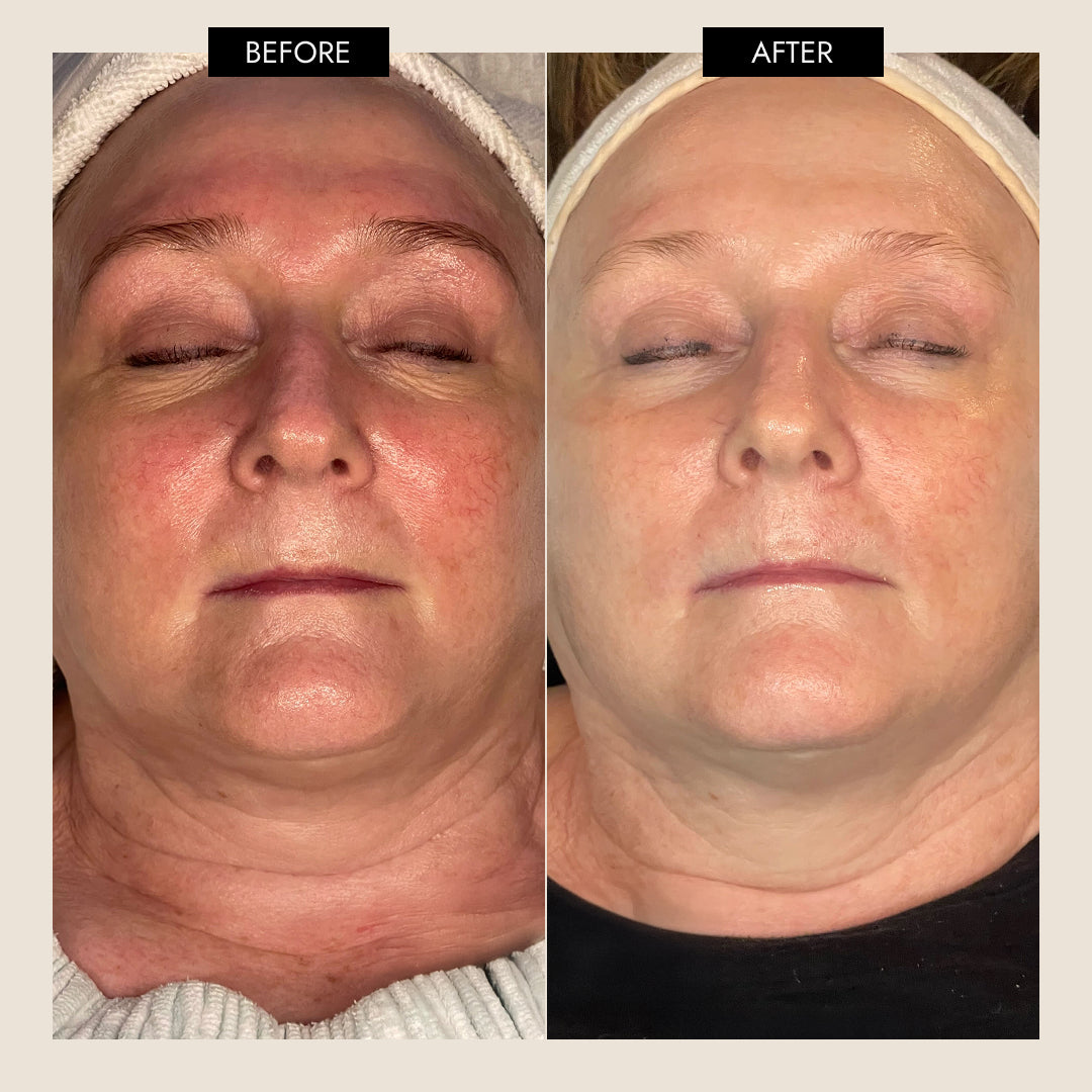 7E Wellness - MyoLift Triwave Microcurrent Device