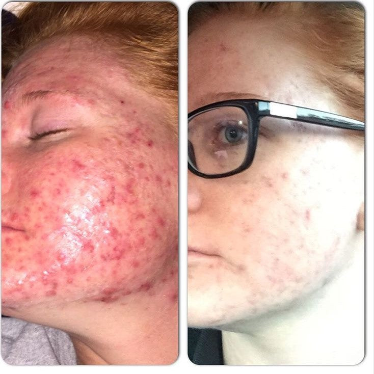 Timeless Organics - 3-Step Acne System