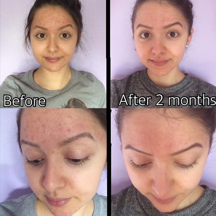 Timeless Organics - 3-Step Acne System