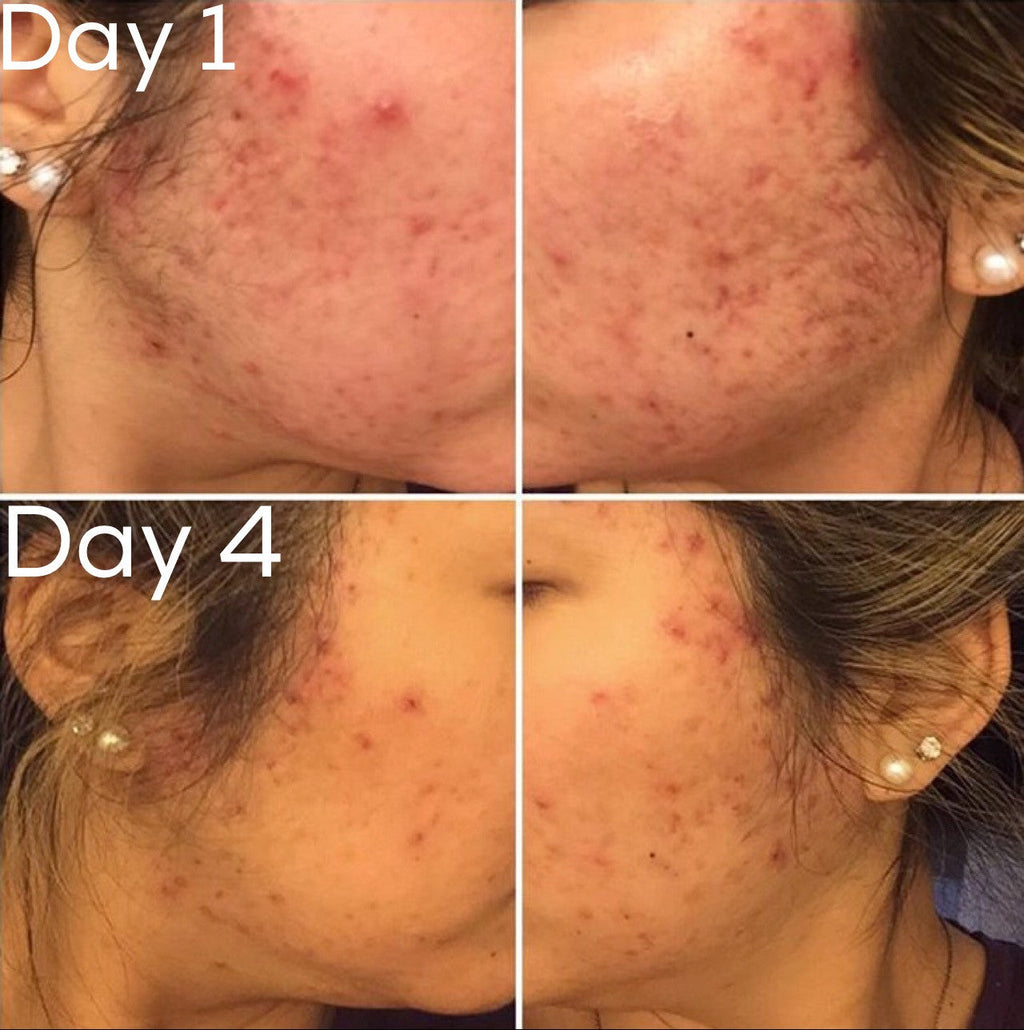 Timeless Organics - 3-Step Acne System