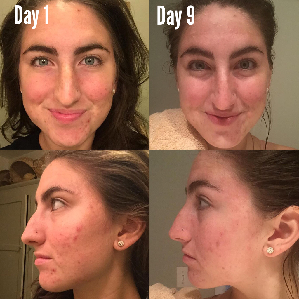 Timeless Organics - 3-Step Acne System