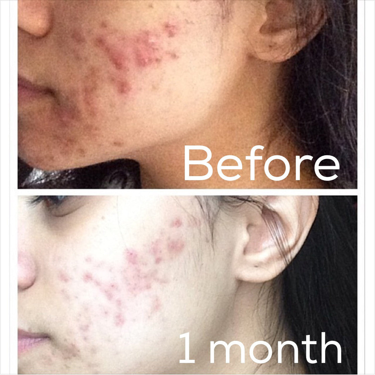 Timeless Organics - 3-Step Acne System